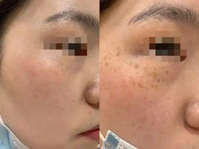 雀斑治疗前后对比