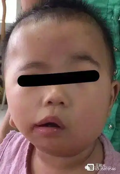 出生后发现面部不对称(右脸小),耳部发育异常(残缺,无外耳道),口角裂
