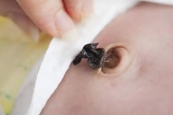 宝宝脐带未脱落如何护理新生儿肚脐贴有必要买吗