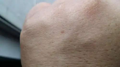 手背起了一些小疙瘩,是扁平疣还是皮炎?