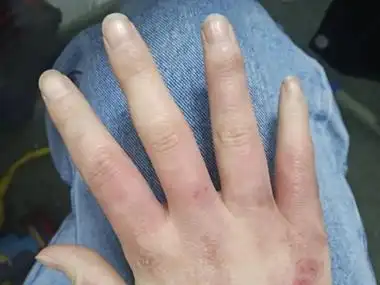 寒冷性脂膜炎手指皮肤发红图