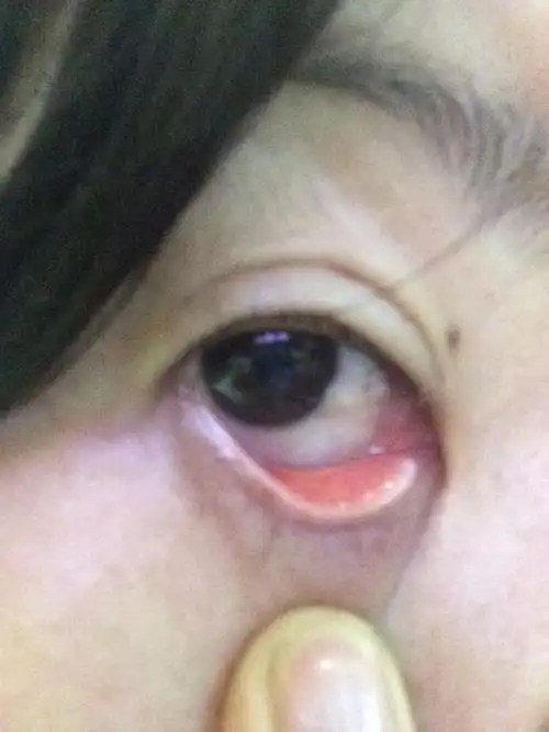 请问眼睛白眼仁长了东西有点长到黑眼珠上了,这是什么东西,要手术吗