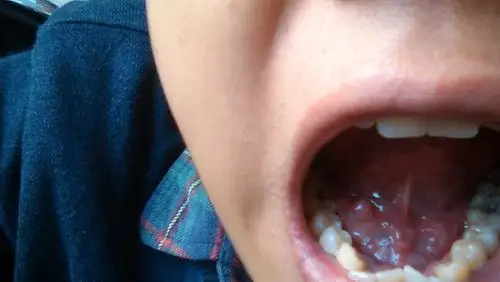 我的舌下腺长了个肉疙瘩,前几天很大的像黄豆大小,现在小的和一粒米一