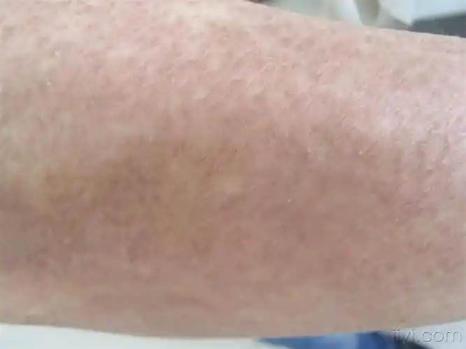 皮肤淀粉样变(有病理)