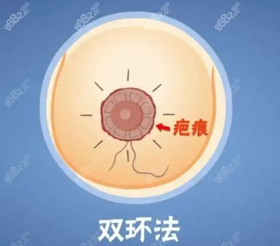 一,实例分享双环提升乳房手术疤痕明显吗?