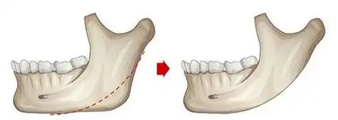 联合丽格第一医疗美容医院何照华院长:如何选择下颌角长曲线截骨和