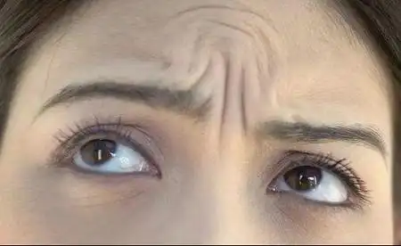 [川字纹打肉毒素可以吗]