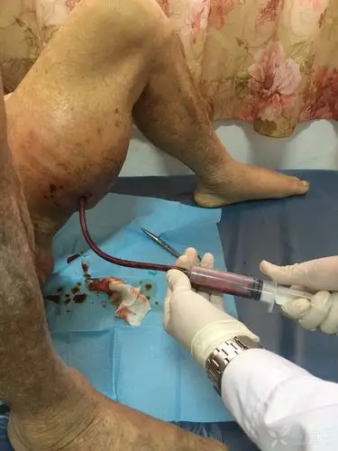 分享一张我手机里的临床图片# 患者阴囊旁又长出一个「阴囊」?