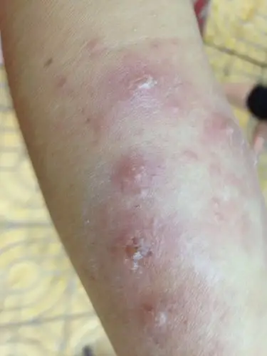 天后,一点也没有效,而且越来越痒,越痒越想挠,最后我的手和腿竟变成了