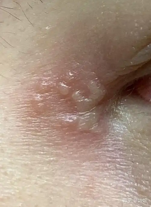 左边内眼角皮肤起水泡,怎么办?