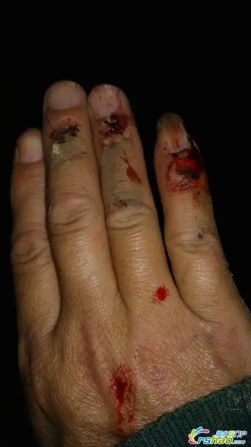 对于绳降尚未熟练的"伤心的情哥"不小心让手碰破了皮,流了不少的血