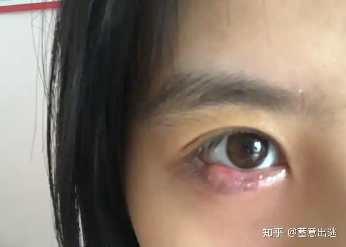 记录麦粒肿(撅眼) - 知乎