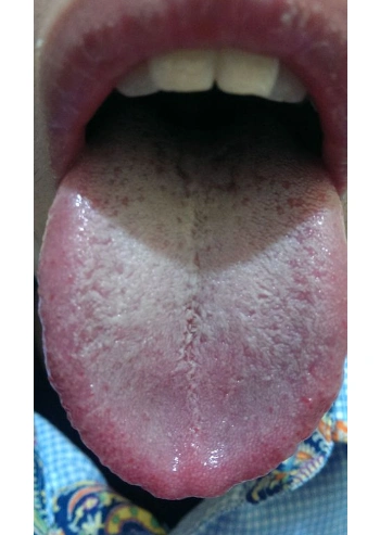 胃炎的症状舌头图片 (34)