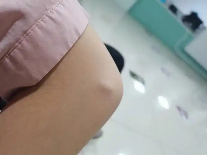 皮脂腺囊肿切除术