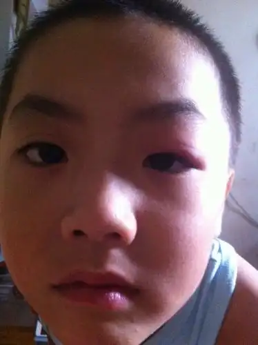 宝宝眼皮有点肿还有点痒需要到医院看吗