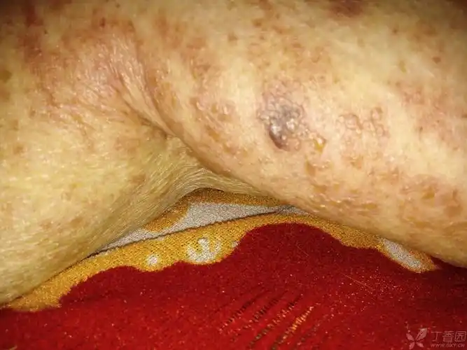 发现右侧大腿内侧水泡2天 [病例帖]