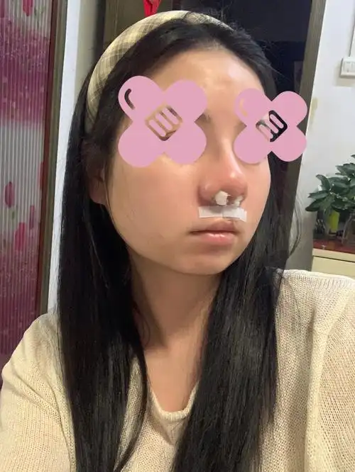今天见了朋友说鼻子好大唇裂二期