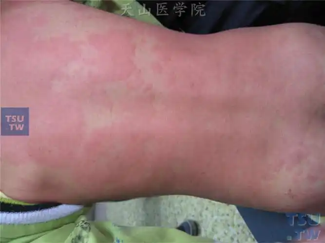 背部,腰部及臀部泛发性红色风团,几乎遍布前身
