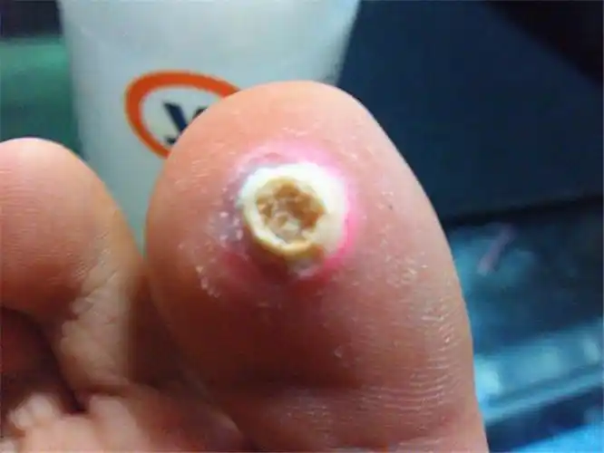 手心手指上长鸡眼初期图片