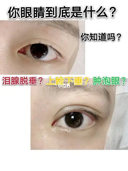 双侧泪腺脱垂=上睑下垂or肿泡眼7171