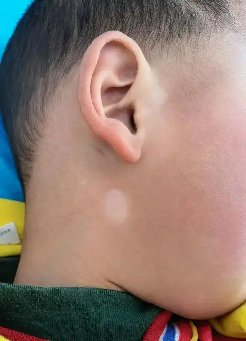 3,白斑和白点癫风的 图片区别