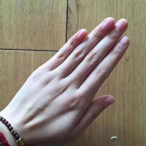 肝功能受损的人,往往中指上粗下细,五指并拢,总是有很多缝隙,慢性肝炎