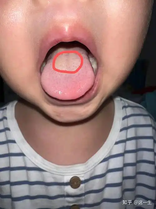 积食如何判断孩子真的积食积食舌苔这样看