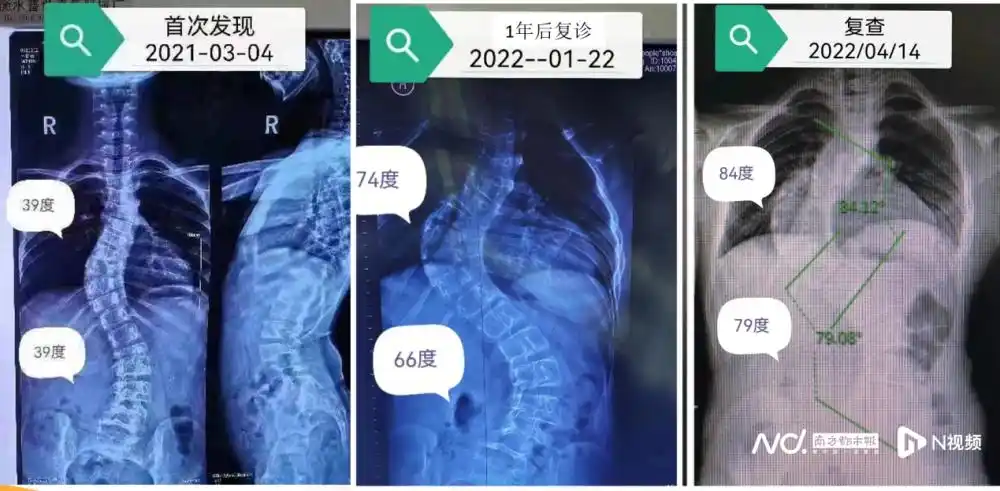 11岁孩子脊椎侧弯近90度,5小时手术"长高"8厘米_腾讯新闻