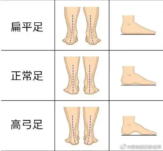 扁平足#