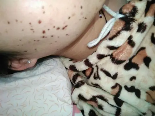 液氮去疣 点疣医保