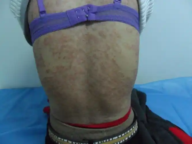 神经性过敏皮炎图片