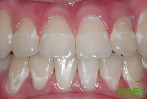 牙齿上有白斑怎么回事