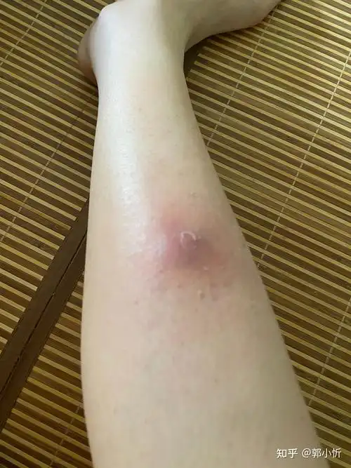 小腿火疖子从发展到切开全过程记录