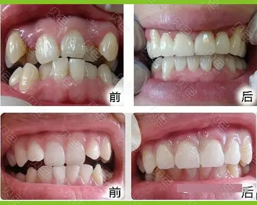 赣州薇琳口腔牙齿矫正对比