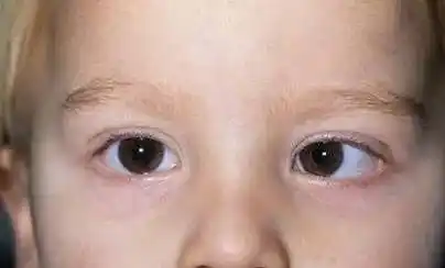 不可忽视的斜视_孩子_眼睛_检查