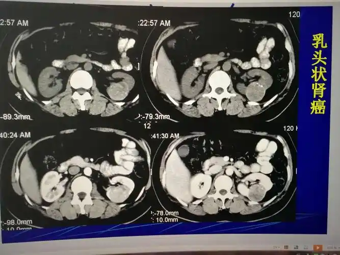 肾肿瘤的ct诊断与鉴别诊断!