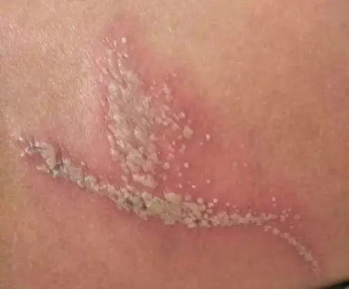 皮防小医课堂隐翅虫皮炎