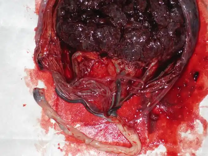 帆状胎盘不知道大家见过没