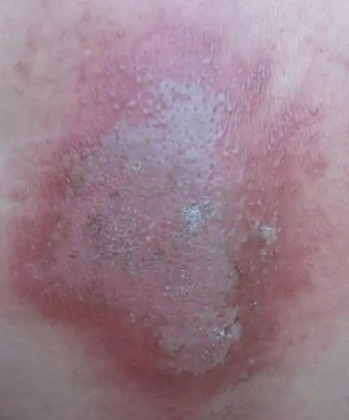 招致隐翅虫的毒汁液腐蚀皮肤状态约10天以后的情况/已有部份表皮乾