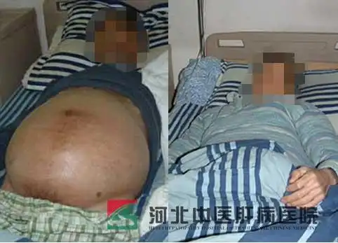 腹水消退病例(四)附图_典型病例_河北中医肝病医院