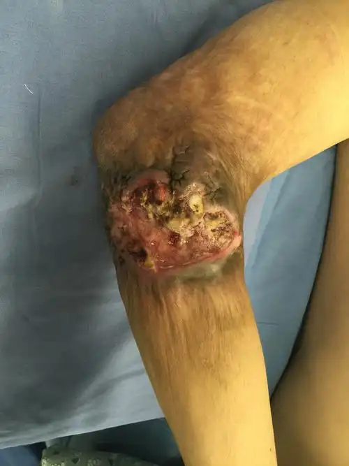 警惕烧伤后疤痕惯性溃疡癌变