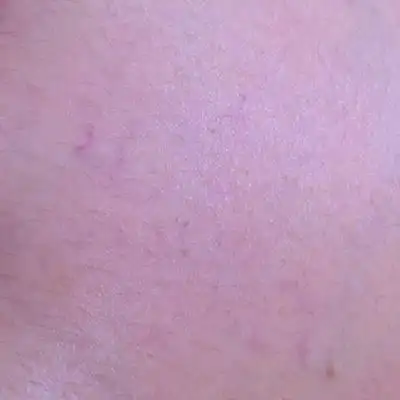 宝妈们,请问下这是妊娠纹的前奏吗?还是毛细血管?