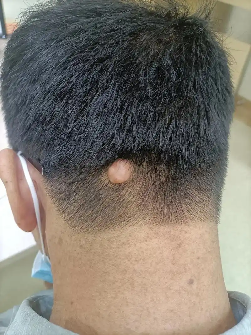 头部纤维瘤 - 浩程 - 抖音