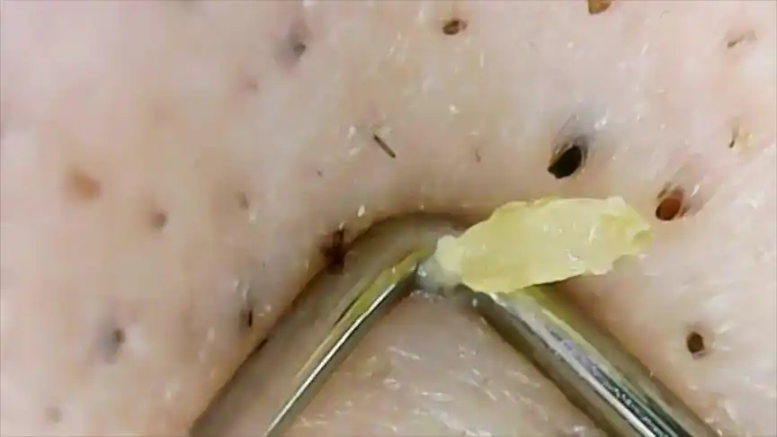 高倍显示镜下挤黑头,油脂都能看清,没有挨个挤,强迫症慎点