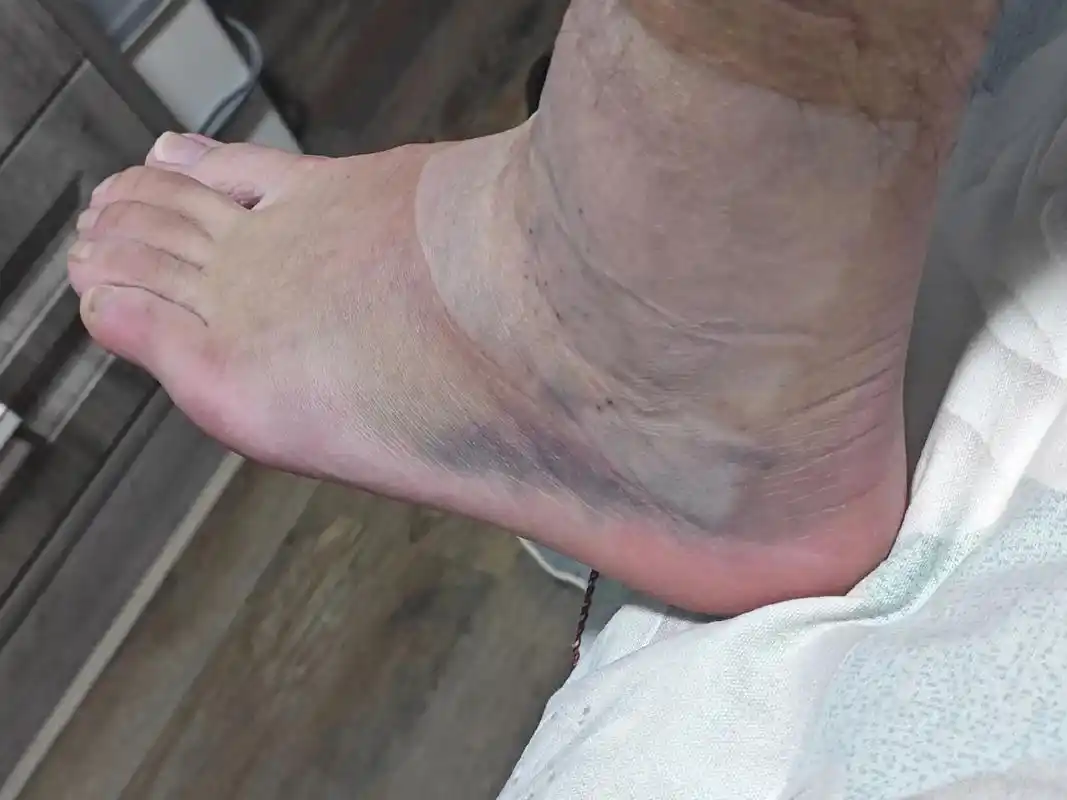 22岁如期而至! 同是生日day 同是脚踝扭伤