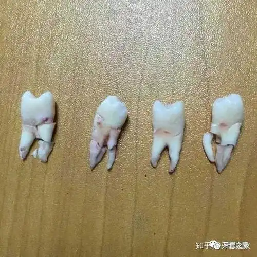 龅牙做完矫正后会有什么改变?