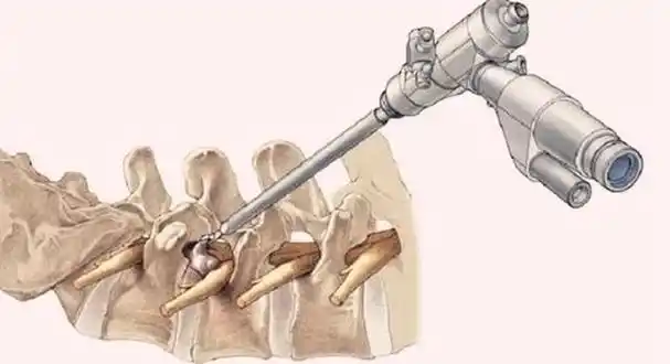 04 —腰椎间盘突出的其他治疗办法