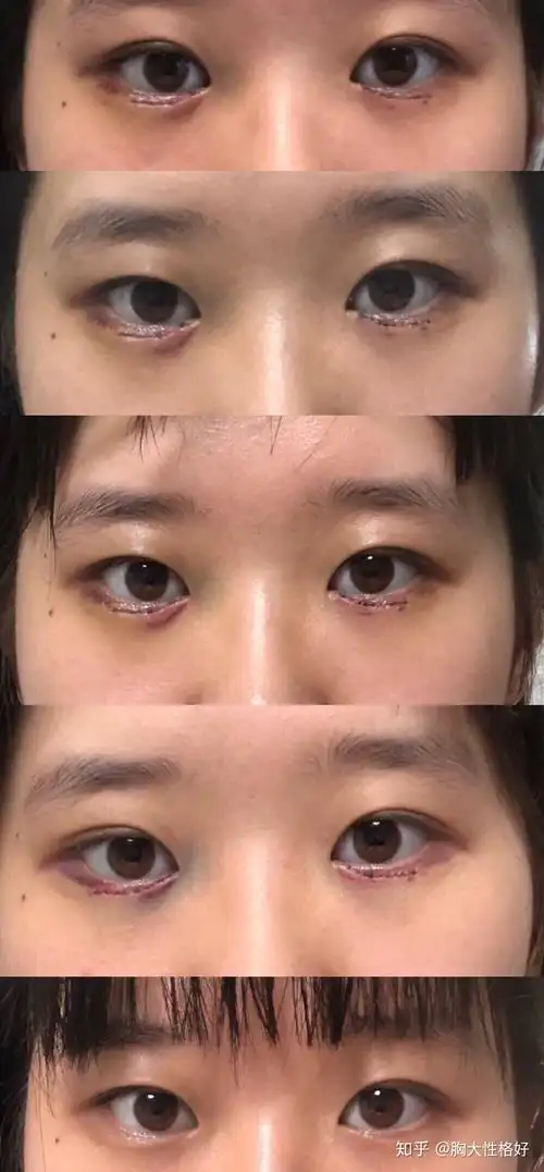 下眼睑倒睫毛手术压管开刀