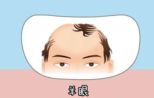 羊眼所谓的羊眼,就是指一个人的黑眼珠长的过小,而四周的眼白看起来