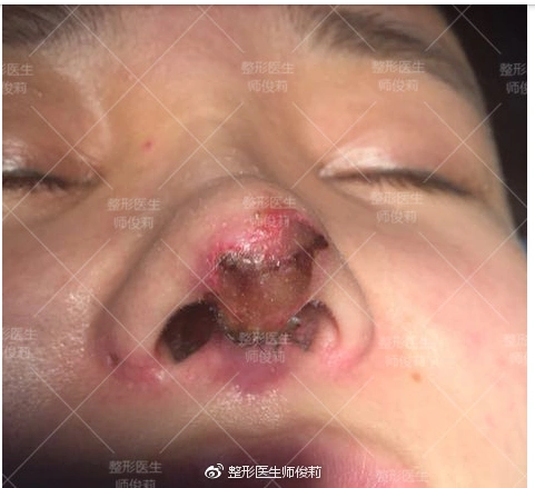 三次鼻修复手术,鼻小柱竟然坏死?